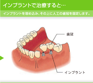 インプラントで治療すると…　インプラントを埋め込み、その上に人工の歯冠を固定します。